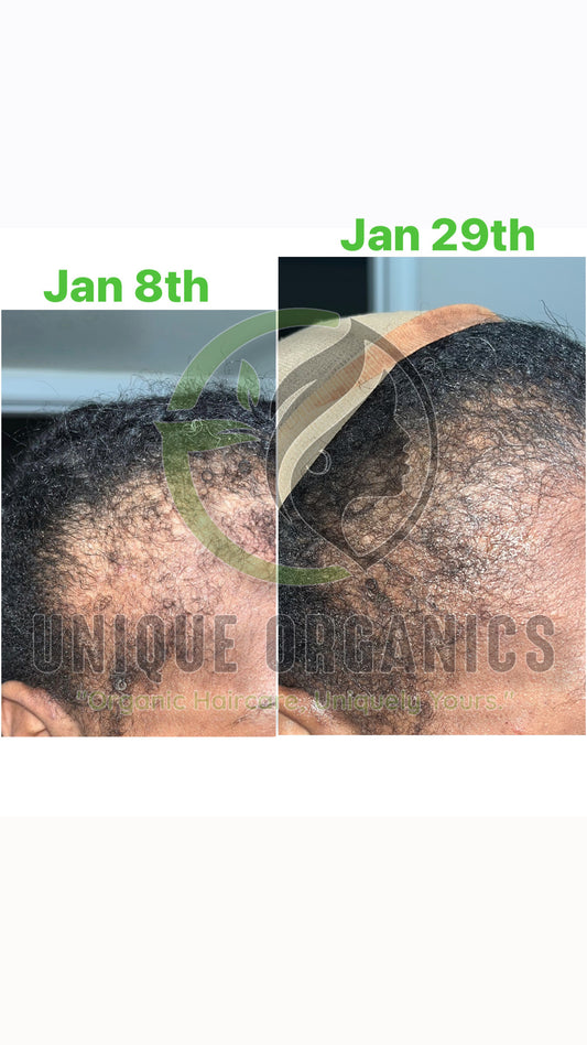 Alopecia Hair Oil Unique Organics Haircare