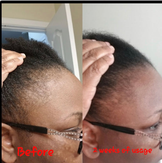 Edge Growth Cream, Balding, Thinning & Damaged Edges, Hairline Cream, Follicle Stimulation