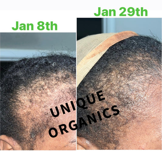 Organic Alopecia Hair Oil Unique Organics Haircare
