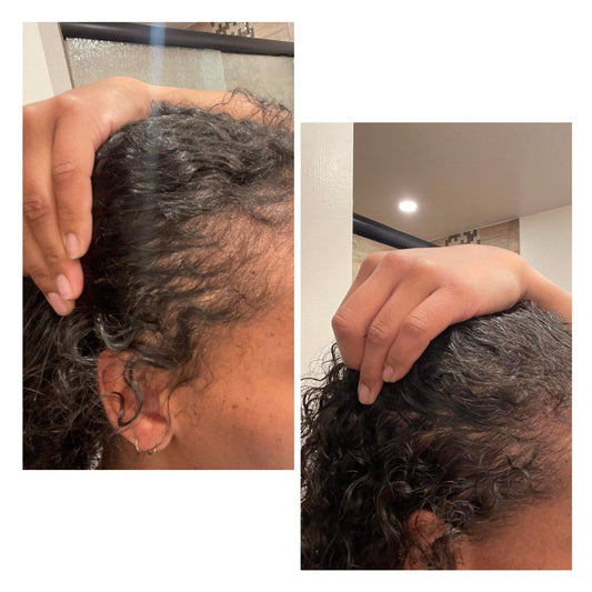 Extra Strength Alopecia Hair Growth Oil - Unique Organics Haircare