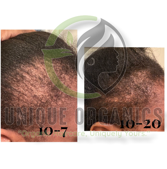 Root Strength Herbal Hair Oil | For Thinning Hair & Alopecia Care