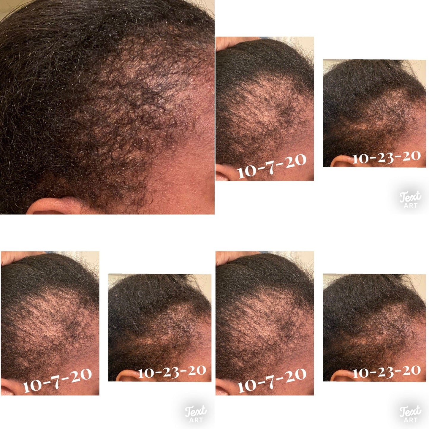 Alopecia Hair Oil 