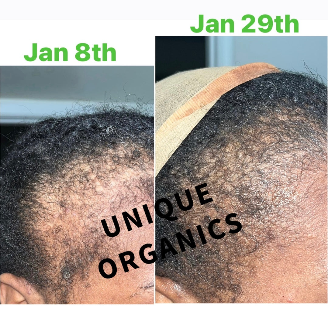 40 Ingredients Organic Alopecia Hair Oil Thinning Edges and Balding Crowns