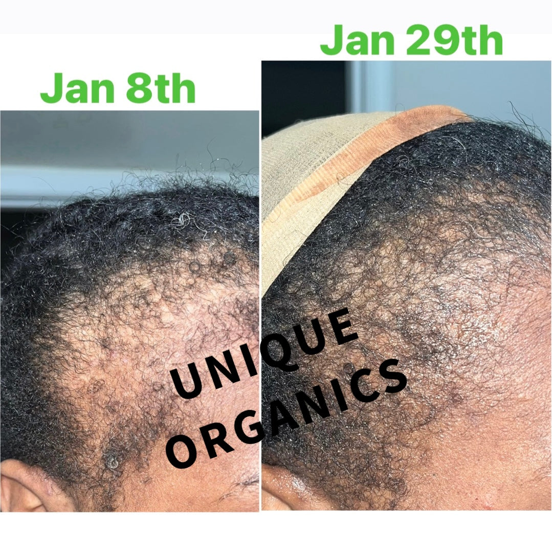 Organic Alopecia Hair Oil Unique Organics Haircare