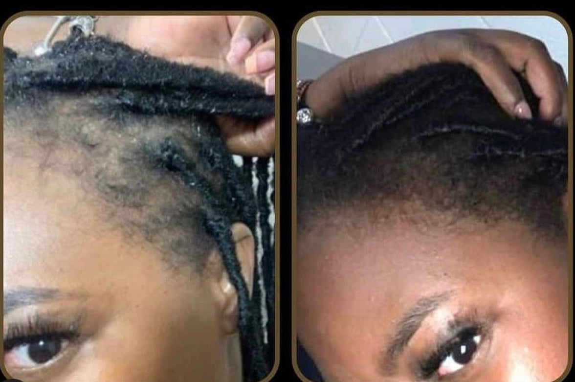 Alopecia Hair Oil Unique Organics Haircare